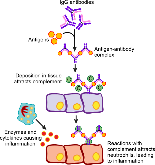 Immune Complex-Mediated Hypersensitivity